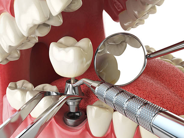 Emergency Dental Filling Replacement in AR